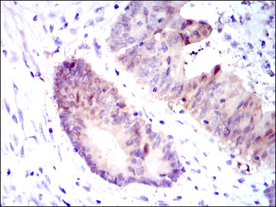 Immunohistochemical analysis of paraffin-embedded colon cancer tissues using ASS1 mouse mAb with DAB staining.