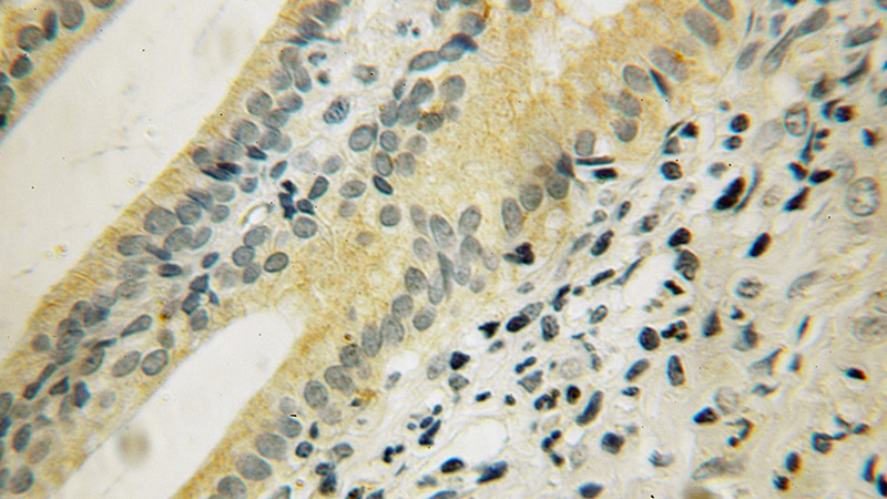 Immunohistochemical of paraffin-embedded human pancreas cancer using Catalog No:110118(DUSP19 antibody) at dilution of 1:100 (under 10x lens)