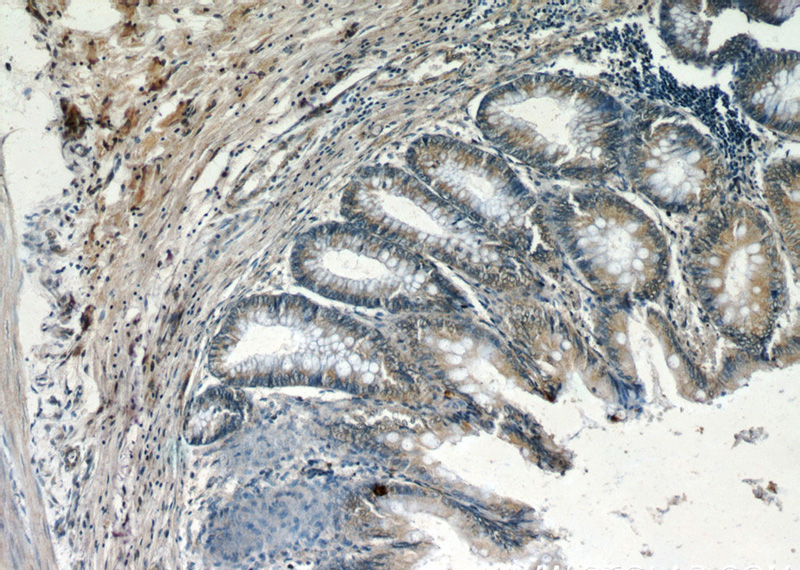 Immunohistochemistry of paraffin-embedded human colon slide using Catalog No:109976(DocK1 Antibody) at dilution of 1:50