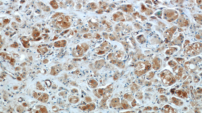 Immunohistochemistry of paraffin-embedded human breast cancer slide using Catalog No:117223(BRCA1 Antibody) at dilution of 1:50