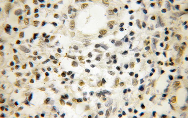 Immunohistochemical of paraffin-embedded human lymphoma using Catalog No:113262(NOB1 antibody) at dilution of 1:25 (under 10x lens)