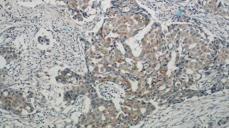 Immunohistochemical of paraffin-embedded human breast cancer using Catalog No:107690(ACP5 antibody) at dilution of 1:25 (under 10x lens)