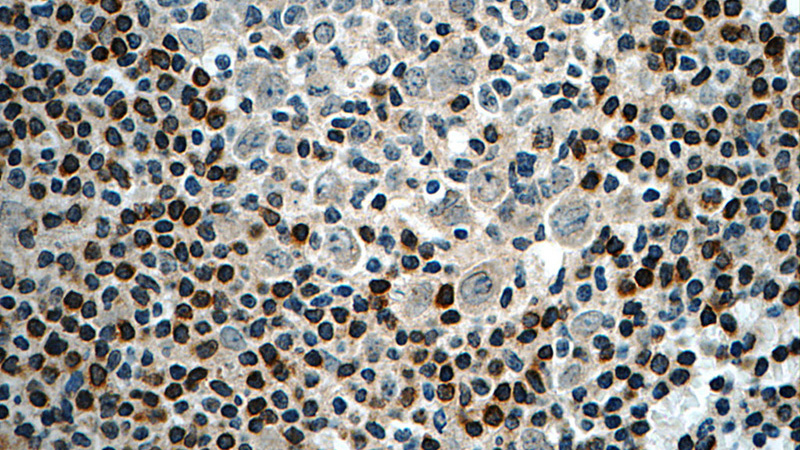 Immunohistochemistry of paraffin-embedded human tonsillitis tissue slide using Catalog No:108391(BCL2 Antibody) at dilution of 1:50 (under 40x lens)