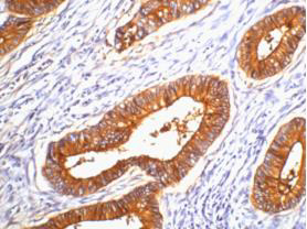 IHC staining of human colon cancer tissue, diluted at 1:200.