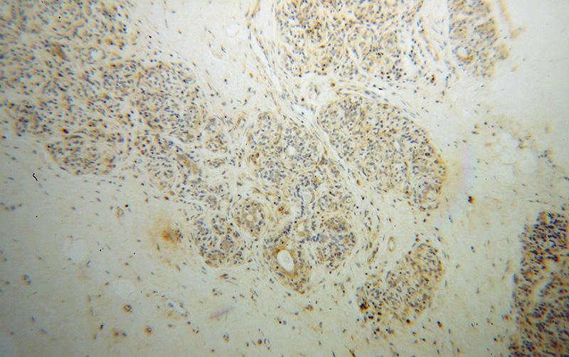 Immunohistochemical of paraffin-embedded human breast cancer using Catalog No:108165(ARPC2 antibody) at dilution of 1:100 (under 10x lens)