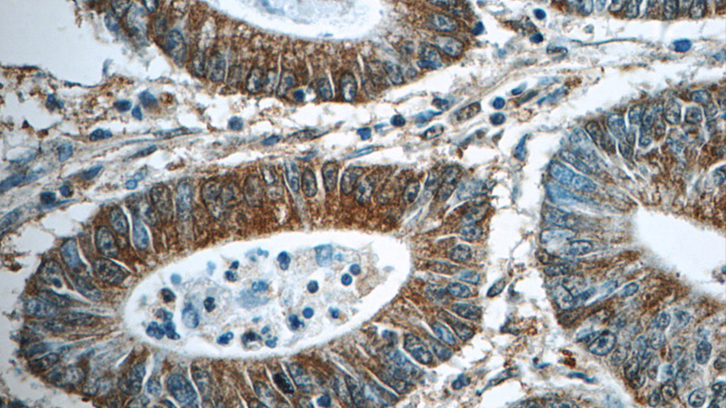 Immunohistochemistry of paraffin-embedded human colon cancer tissue slide using Catalog No:109273(CHPF Antibody) at dilution of 1:50 (under 40x lens)