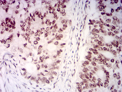 Fig3: Immunohistochemical analysis of paraffin-embedded cervical cancer tissues using anti-KMT2D antibody. The section was pre-treated using heat mediated antigen retrieval with Tris-EDTA buffer (pH 8.0) for 20 minutes. The tissues were blocked in 5% BSA for 30 minutes at room temperature, washed with ddH2O and PBS, and then probed with the primary antibody ( 1/100) for 30 minutes at room temperature. The detection was performed using an HRP conjugated compact polymer system. DAB was used as the chromogen. Tissues were counterstained with hematoxylin and mounted with DPX.