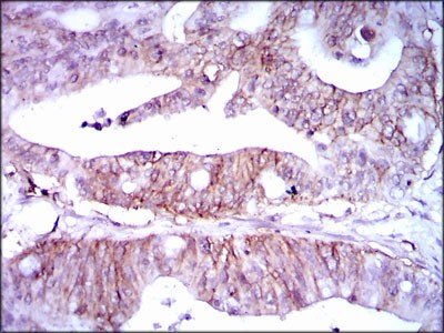 Fig5: Immunohistochemical analysis of paraffin-embedded human rectum cancer tissue using anti- Lipoprotein a antibody. Counter stained with hematoxylin.
