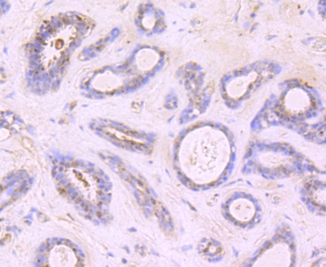 Fig4:; Immunohistochemical analysis of paraffin-embedded human breast carcinoma tissue using anti-Growth Hormone antibody. The section was pre-treated using heat mediated antigen retrieval with Tris-EDTA buffer (pH 9.0) for 20 minutes.The tissues were blocked in 1% BSA for 30 minutes at room temperature, washed with ddH; 2; O and PBS, and then probed with the primary antibody ( 1/50) for 30 minutes at room temperature. The detection was performed using an HRP conjugated compact polymer system. DAB was used as the chromogen. Tissues were counterstained with hematoxylin and mounted with DPX.