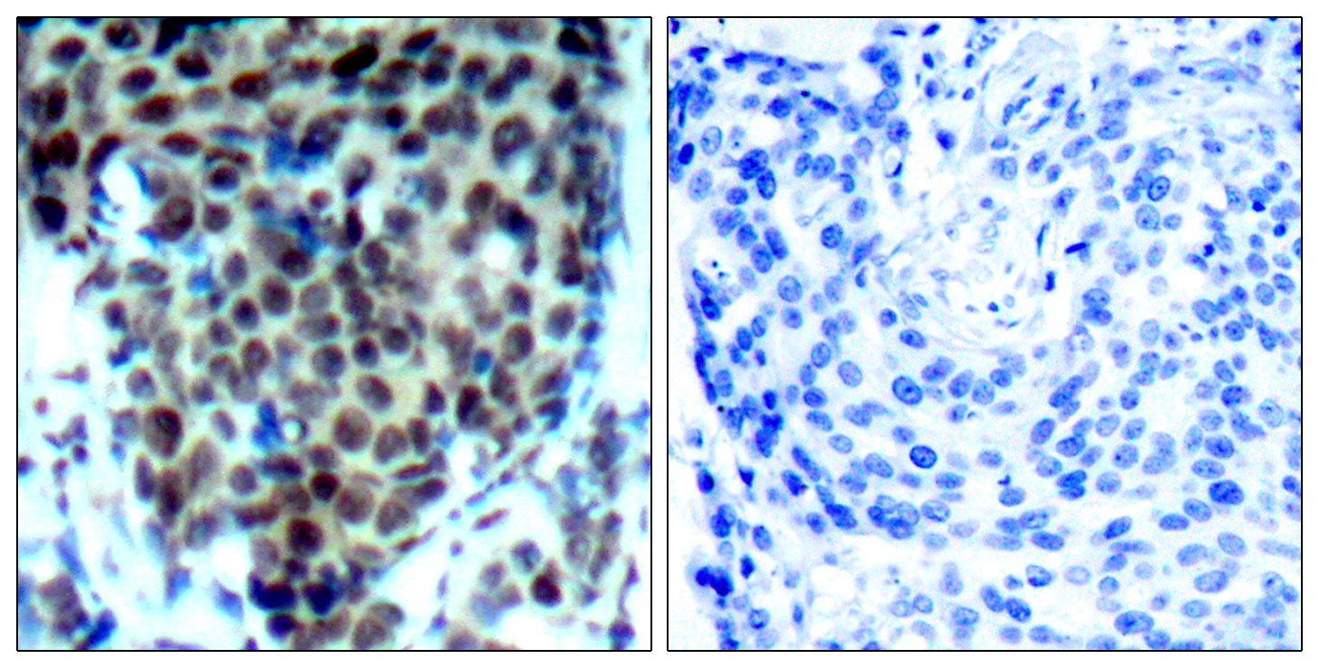 Immunohistochemical analysis of paraffin-embedded human breast carcinoma tissue using P38 MAPK (Phospho-Thr180) Antibody (left) or the same antibody preincubated with blocking peptide (right).