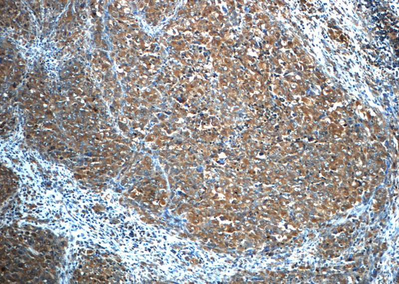 Immunohistochemistry of paraffin-embedded human lymphoma slide using (ALK,CD246 Antibody) at dilution of 1:50