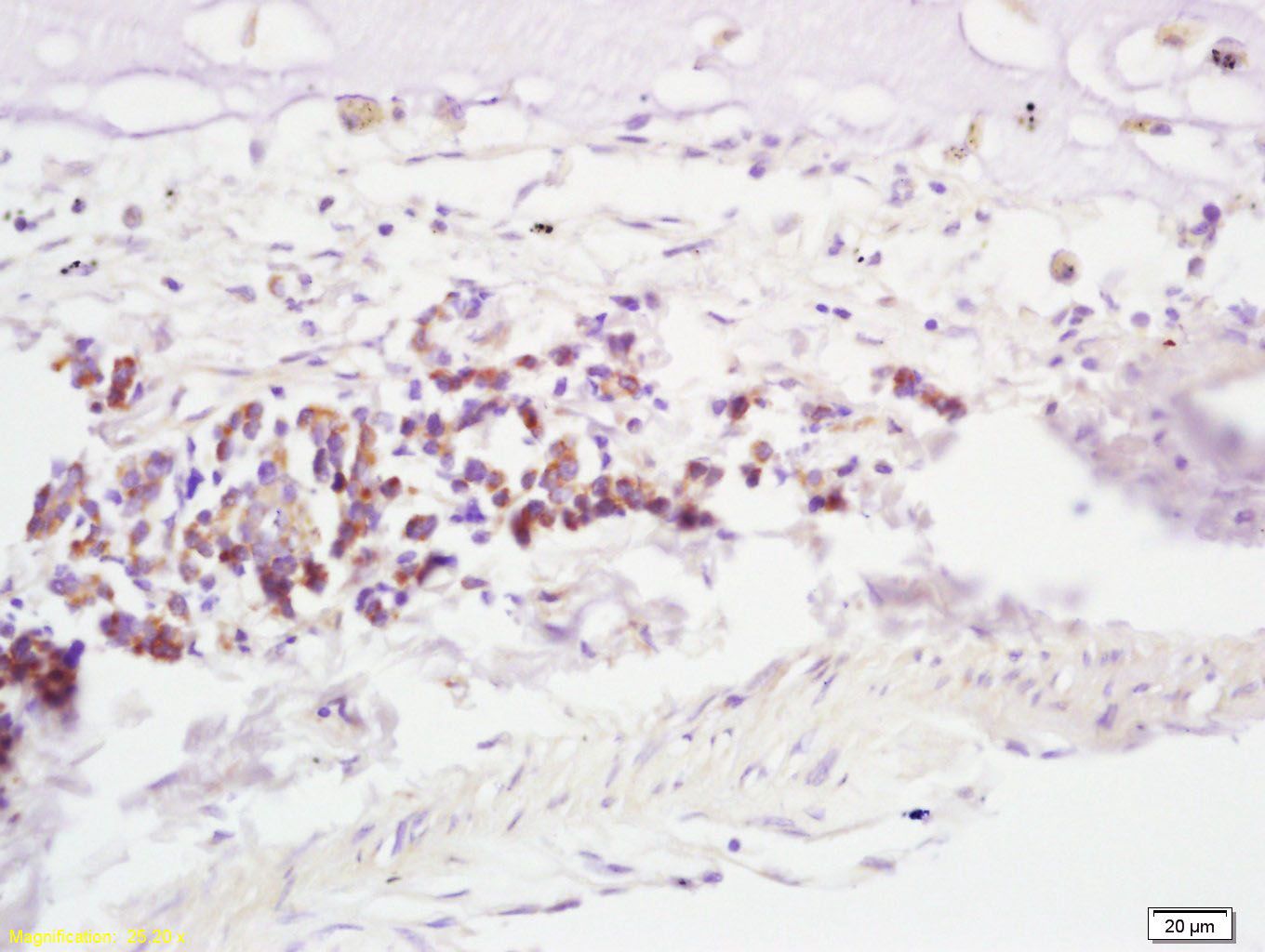 Fig1: Tissue/cell: human lung carcinoma; 4% Paraformaldehyde-fixed and paraffin-embedded;; Antigen retrieval: citrate buffer ( 0.01M, pH 6.0 ), Boiling bathing for 15min; Block endogenous peroxidase by 3% Hydrogen peroxide for 30min; Blocking buffer (normal goat serum,C-0005) at 37℃ for 20 min;; Incubation: Anti-RNF43 Polyclonal Antibody, Unconjugated 1:200, overnight at 4℃, followed by conjugation to the secondary antibody (SP-0023) and DAB (C-0010) staining