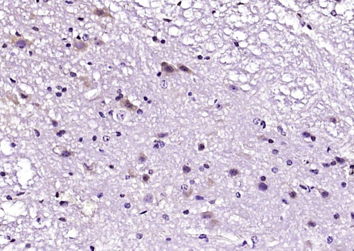 Fig4: Paraformaldehyde-fixed, paraffin embedded (mouse spinal tissue); Antigen retrieval by boiling in sodium citrate buffer (pH6.0) for 15min; Block endogenous peroxidase by 3% hydrogen peroxide for 20 minutes; Blocking buffer (normal goat serum) at 37℃ for 30min; Antibody incubation with (IL-1RA) Polyclonal Antibody, Unconjugated at 1:200 overnight at 4℃, followed by operating according to SP Kit(Rabbit) (sp-0023) instructionsand DAB staining.