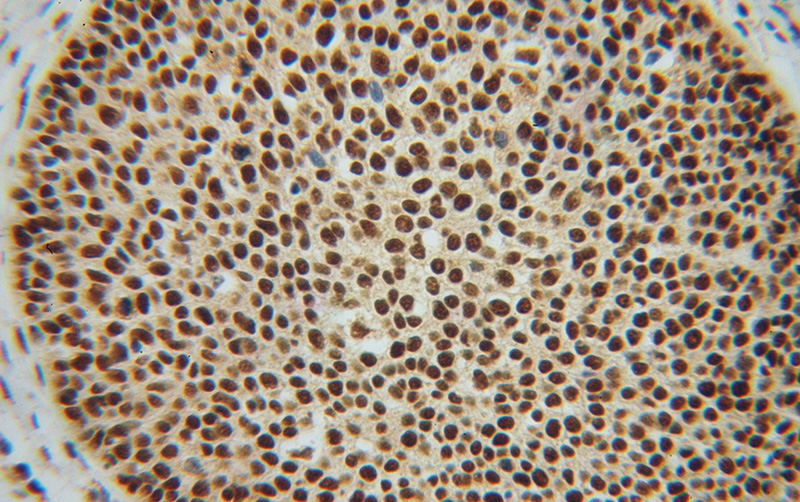 Immunohistochemical of paraffin-embedded human cervical cancer using Catalog No:113138(NF45 antibody) at dilution of 1:100 (under 40x lens)