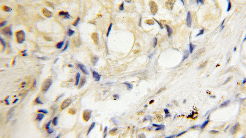 Immunohistochemical of paraffin-embedded human lung cancer using Catalog No:113615(PBX3 antibody) at dilution of 1:50 (under 10x lens)
