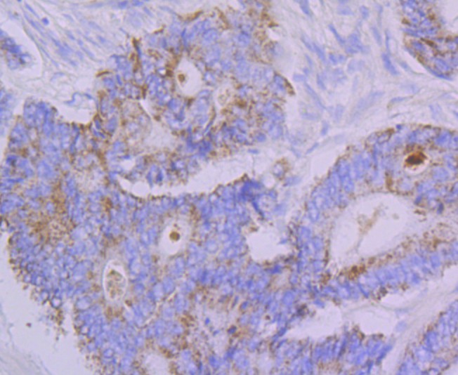 Fig3: Immunohistochemical analysis of paraffin-embedded human colon cancer tissue using anti-Emi1 antibody. Counter stained with hematoxylin.