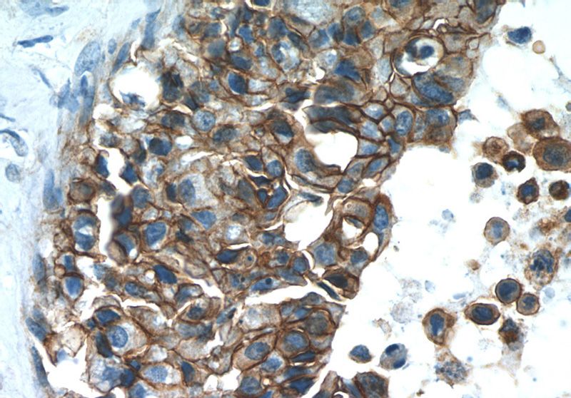 Immunohistochemistry of paraffin-embedded human breast cancer slide using Catalog No:107055(ANXA2 Antibody) at dilution of 1:50