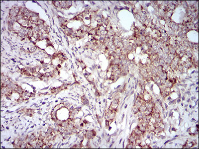 Immunohistochemical analysis of paraffin-embedded cervical cancer tissues using GAB2 mouse mAb with DAB staining.