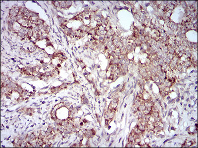 Immunohistochemical analysis of paraffin-embedded cervical cancer tissues using GAB2 mouse mAb with DAB staining.