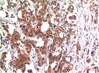 Immunohistochemical analysis of paraffin-embedded Human Breast Carcinoma Tissue using GSK3β Mouse mAb diluted at 1:200.