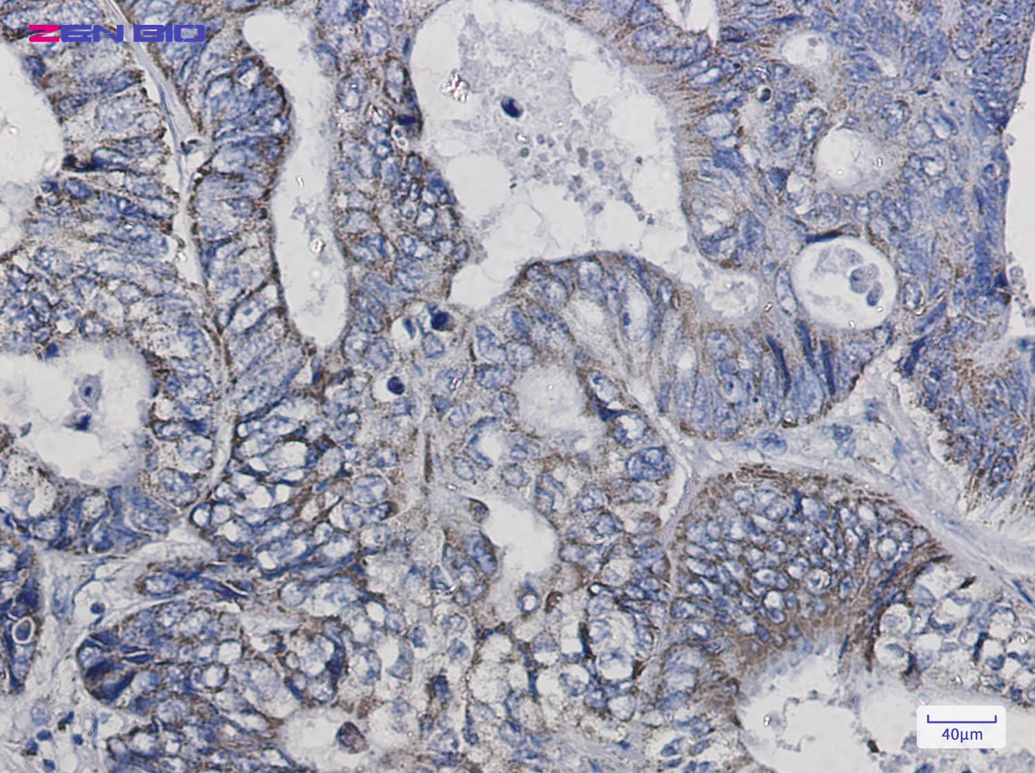 Immunohistochemistry of Thioredoxin 2 in paraffin-embedded Human colon cancer tissue using Thioredoxin 2 Rabbit pAb at dilution 1/50