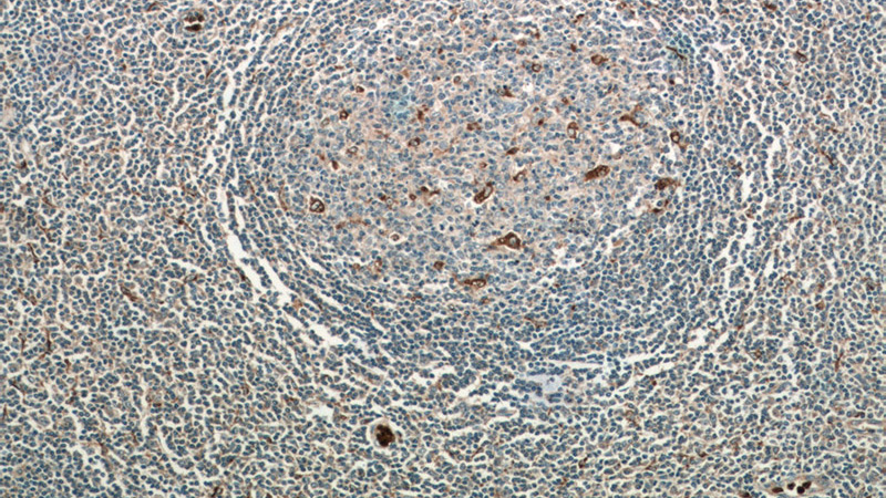 Immunohistochemistry of paraffin-embedded human tonsillitis tissue slide using Catalog No:109134(CD68 Antibody) at dilution of 1:50 (under 10x lens)