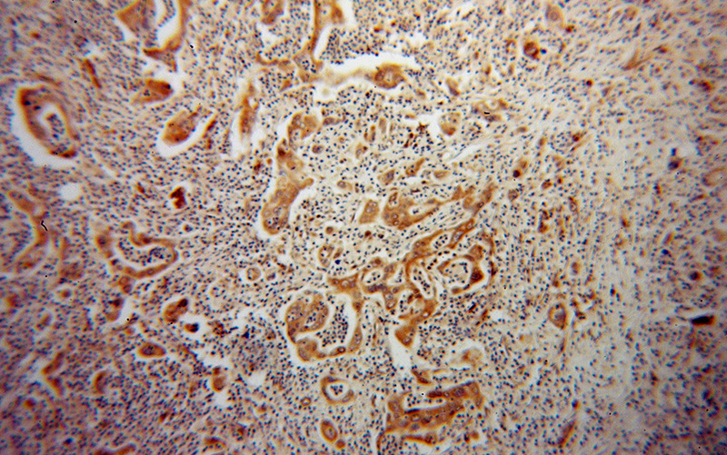 Immunohistochemical of paraffin-embedded human pancreas cancer using Catalog No:111944(ISYNA1 antibody) at dilution of 1:100 (under 10x lens)