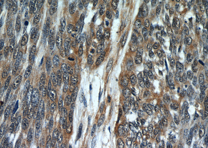 Immunohistochemistry of paraffin-embedded human skin cancer slide using Catalog No:107422(MLPH Antibody) at dilution of 1:50