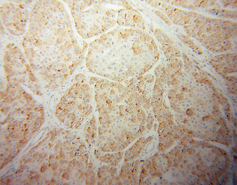Immunohistochemical of paraffin-embedded human liver cancer using Catalog No:109514(CPN1 antibody) at dilution of 1:100 (under 10x lens)