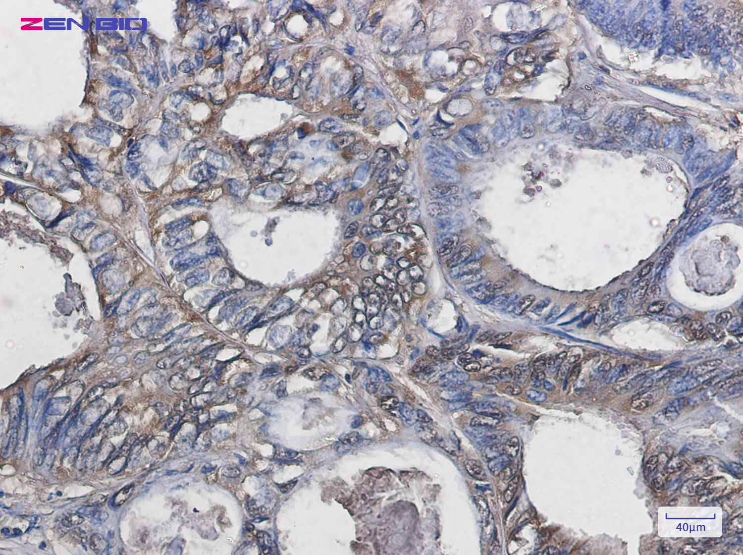 Immunohistochemistry of Superoxide Dismutase 1 in paraffin-embedded Human colon cancer tissue using Superoxide Dismutase 1 Rabbit pAb at dilution 1/20