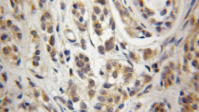 Immunohistochemical of paraffin-embedded human breast cancer using Catalog No:109458(COPG antibody) at dilution of 1:50 (under 10x lens)