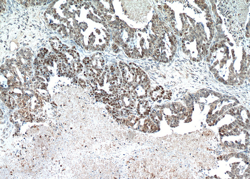 Immunohistochemical of paraffin-embedded human ovary tumor using Catalog No:116258(TP53 antibody) at dilution of 1:100 (under 10x lens)