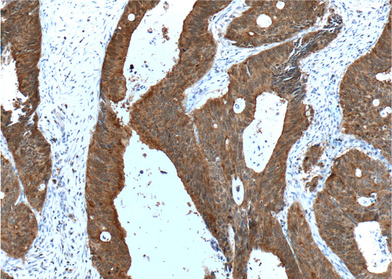 Immunohistochemistry of paraffin-embedded human colon cancer tissue slide using Catalog No:107539(VIL1 Antibody) at dilution of 1:500 (under 10x lens). heat mediated antigen retrieved with Tris-EDTA buffer(pH9).
