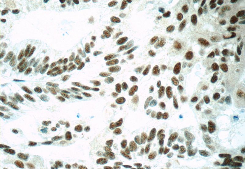 Immunohistochemistry of paraffin-embedded human ovary tumor tissue slide using Catalog No:115221(SETD1B Antibody) at dilution of 1:50 (under 40x lens)