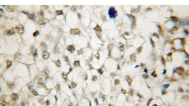 Immunohistochemical of paraffin-embedded human ovary tumor using Catalog No:112455(MAGOH antibody) at dilution of 1:50 (under 10x lens)