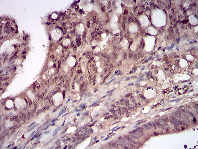 Immunohistochemical analysis of paraffin-embedded rectum cancer tissues using DDIT3 mouse mAb with DAB staining.