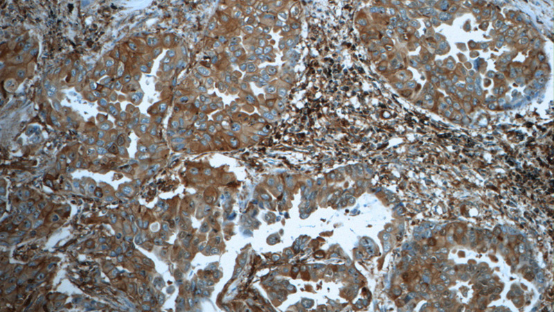 Immunohistochemistry of paraffin-embedded human lung cancer tissue slide using Catalog No:107366(KRAS Antibody) at dilution of 1:50 (under 10x lens)