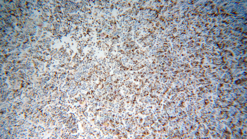 Immunohistochemical of paraffin-embedded human lymphoma using Catalog No:112627(MIP­3β antibody) at dilution of 1:100 (under 10x lens)