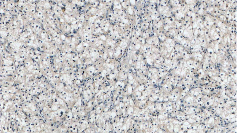 Immunohistochemistry of paraffin-embedded human renal cell carcinoma tissue slide using Catalog No:108386(BCKDHB Antibody) at dilution of 1:50 (under 10x lens)
