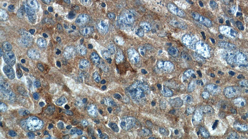 Immunohistochemistry of paraffin-embedded human breast cancer tissue slide using Catalog No:107536(VAPB Antibody) at dilution of 1:50 (under 40x lens)