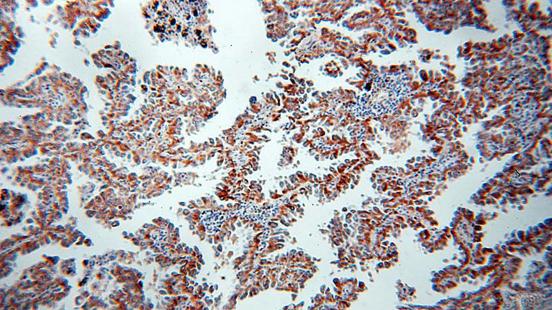 Immunohistochemical of paraffin-embedded human lung cancer using Catalog No:115621(IL1RL1 antibody) at dilution of 1:50 (under 10x lens)