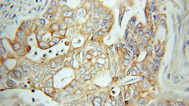 Immunohistochemical of paraffin-embedded human pancreas cancer using Catalog No:111580(PTPRN antibody) at dilution of 1:50 (under 10x lens)