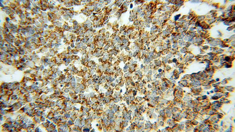 Immunohistochemical of paraffin-embedded human lung cancer using Catalog No:112295(LONP1 antibody) at dilution of 1:50 (under 40x lens)