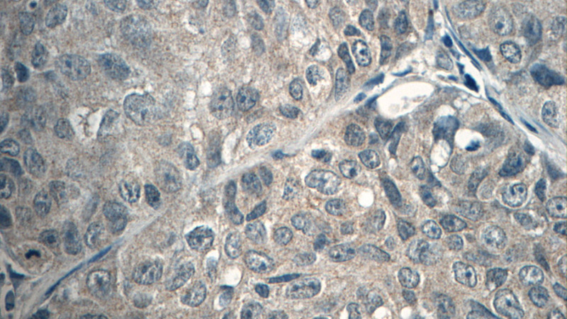 Immunohistochemistry of paraffin-embedded human lung cancer tissue slide using Catalog No:113321(ODAM Antibody) at dilution of 1:50 (under 40x lens)