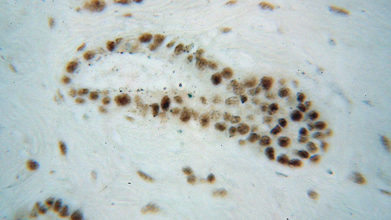 Immunohistochemical of paraffin-embedded human breast cancer using Catalog No:112922(MYEF2 antibody) at dilution of 1:100 (under 40x lens)