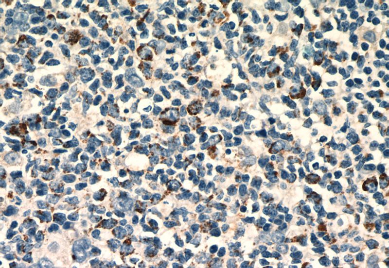 Immunohistochemistry of paraffin-embedded human tonsillitis slide using Catalog No:108686 (C1QBP Antibody) at dilution of 1:50