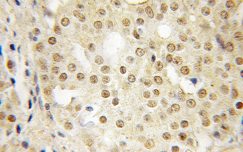 Immunohistochemical of paraffin-embedded human prostate cancer using Catalog No:115147(SFRS14 antibody) at dilution of 1:50 (under 10x lens)