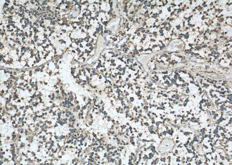 Immunohistochemical of paraffin-embedded human gliomas using Catalog No:116720(VAT1 antibody) at dilution of 1:50 (under 10x lens)