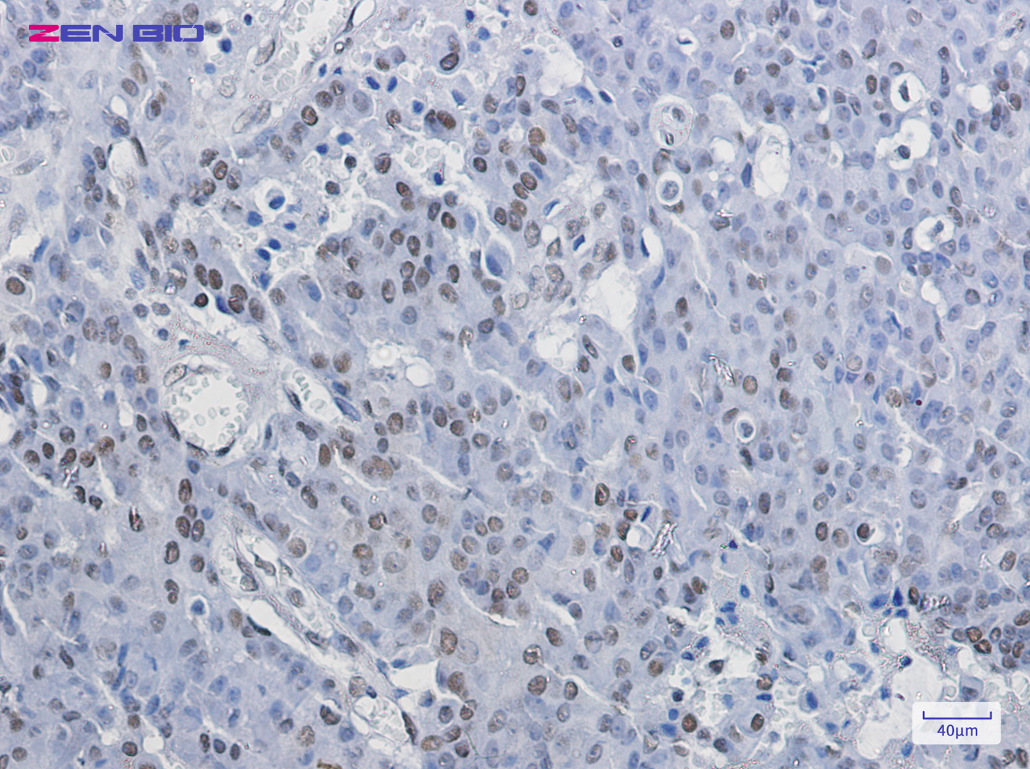 Immunohistochemistry of NELFe in paraffin-embedded Human breast cancer tissue using NELFe Rabbit pAb at dilution 1/20