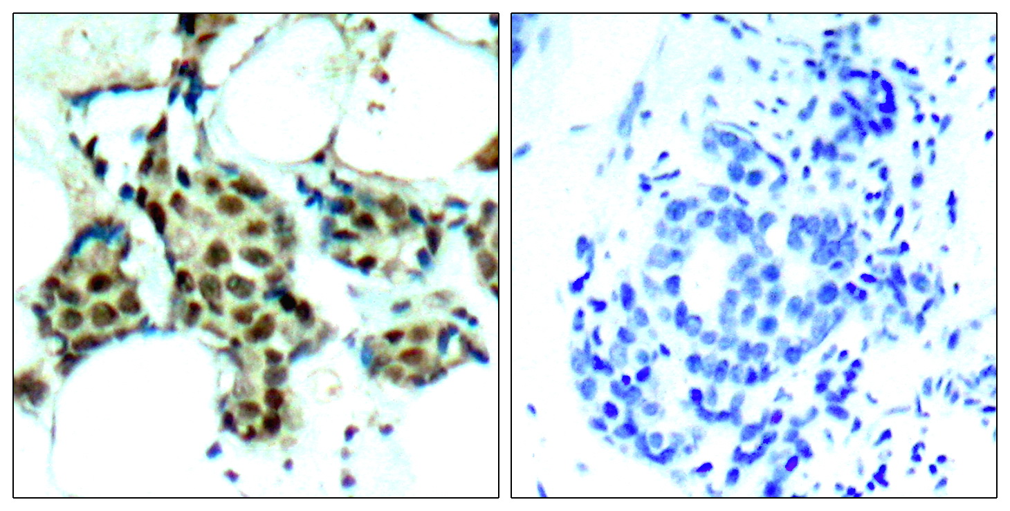 Immunohistochemical analysis of paraffin-embedded human breast carcinoma tissue using P38 MAPK (Phospho-Tyr182) Antibody (left) or the same antibody preincubated with blocking peptide (right).